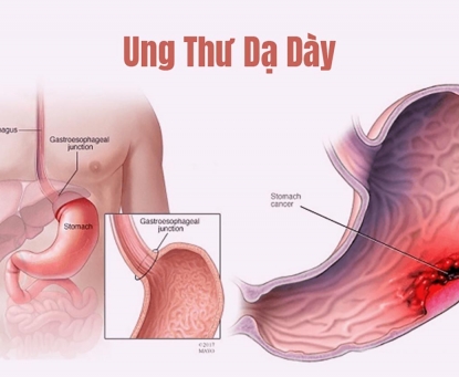 Tổng quan bệnh ung thư dạ dày 